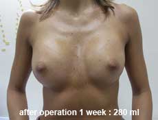 plastic-surgery-breast-augmentation 